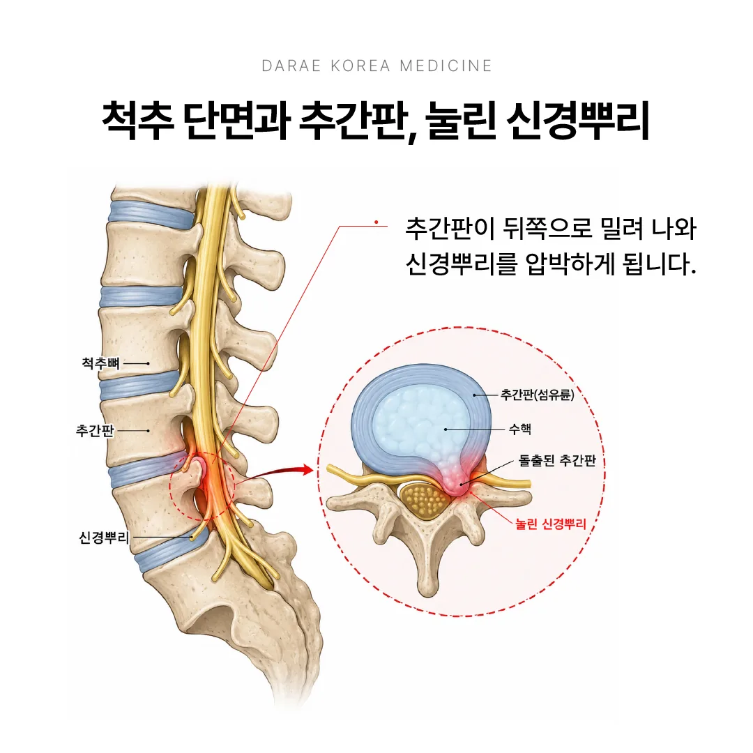 추간판이 뒤쪽으로 밀려 나와 신경뿌리를 압박하는 구조를 나타낸 그림