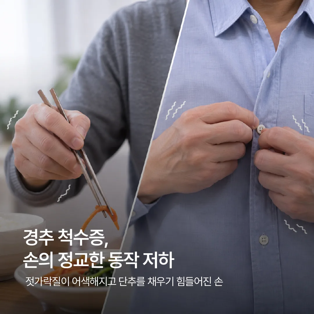 경추 척수증에서 나타나는 손의 정교한 동작 저하