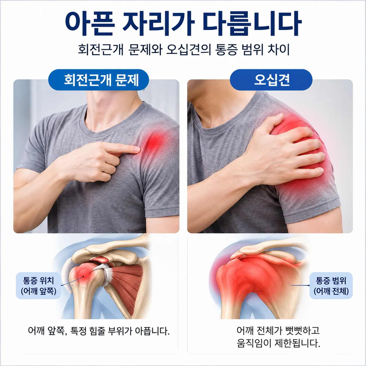 회전근개 문제와 오십견에서 아픈 자리를 표현하는 방식 차이 비교