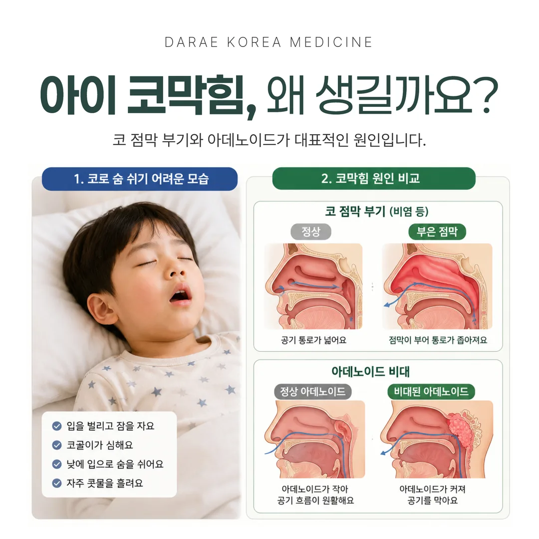 소아 코막힘 원인 비교 - 코 점막 부기와 아데노이드