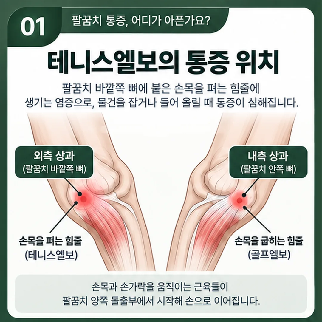 팔꿈치 바깥쪽 외측 상과와 안쪽 내측 상과의 위치, 각 부위에서 시작하는 손목 힘줄의 방향을 표시한 그림