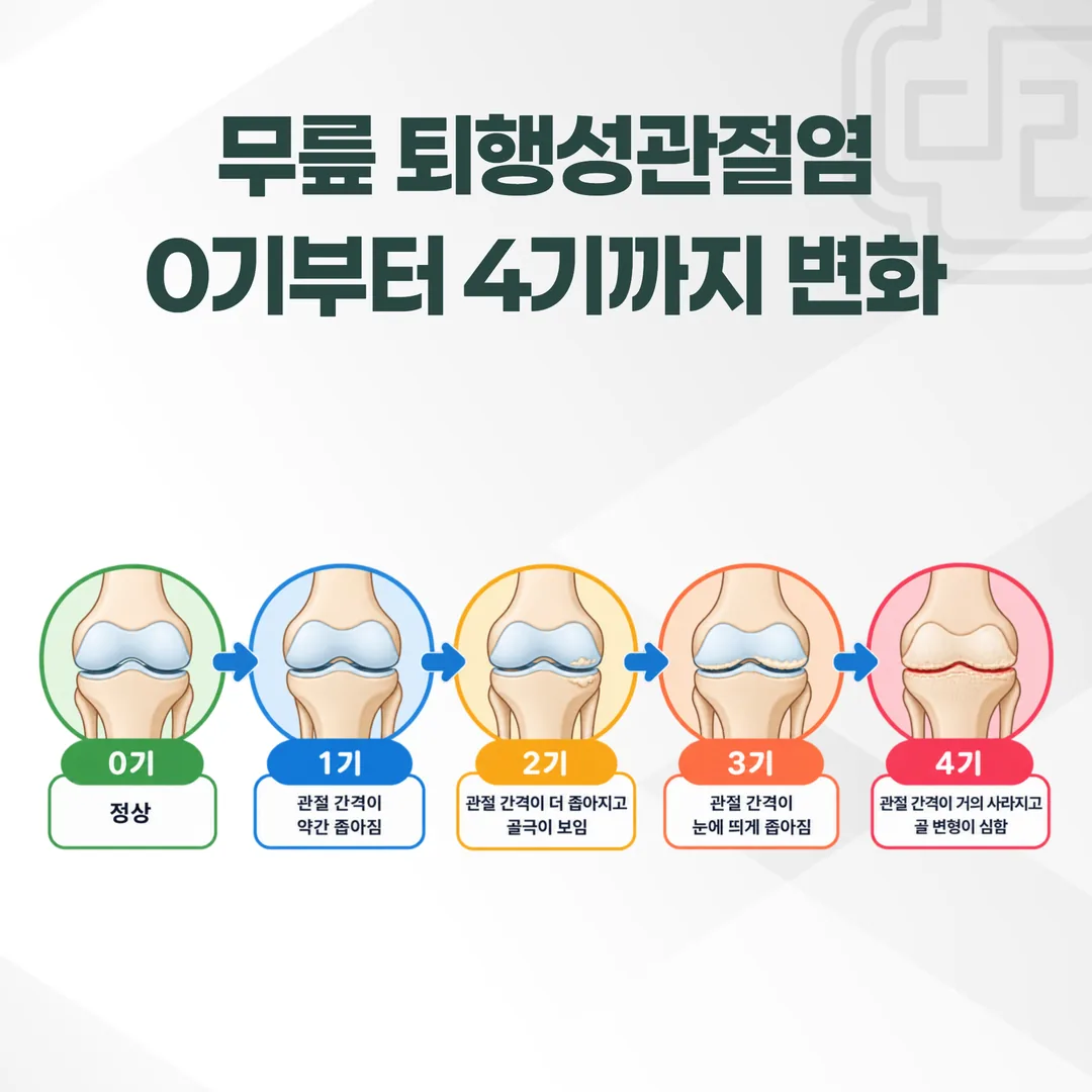 무릎관절염 켈그렌-로렌스 단계별 관절 간격 변화 개념도